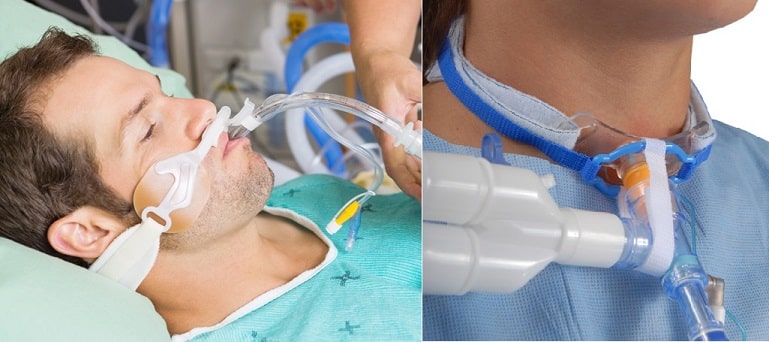 Bệnh nhân phải đặt ống nội khí quản có nguy cơ nhiễm bệnh Legionnaire